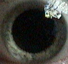my right eye